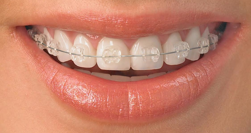 clear braces Gardner & La Rochelle Orthodontics in Richmond, VA